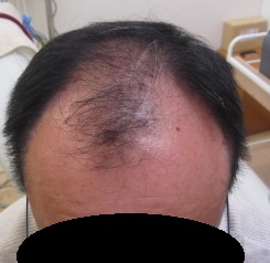豊洲で薄毛治療（AGA)。当院イチオシのAGAの薬であるメディグローの内服＋外用でここまで改善。6か月。