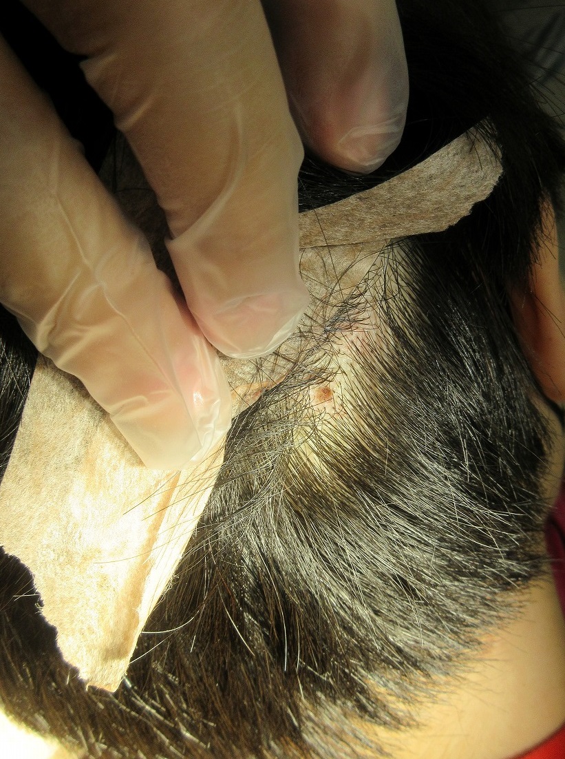 頭皮内のホクロ。切除＋レーザー治療の組み合わせ。直後の状態。