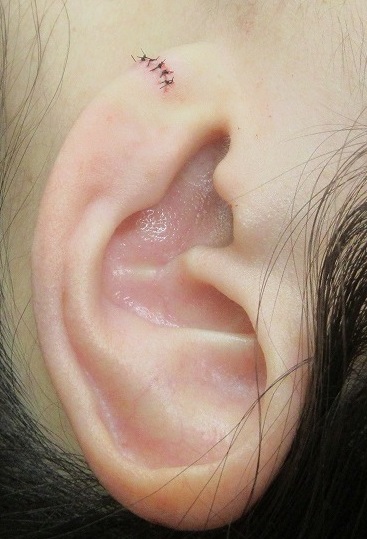 ピアスによる耳垂裂の手術。直後の状態。