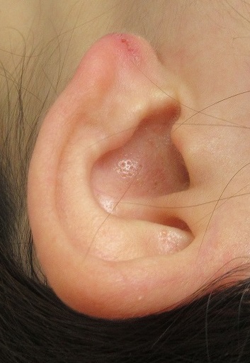 耳垂裂の手術。抜糸直後の状態（９日目）