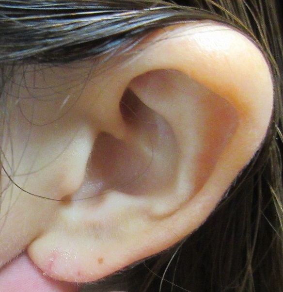 ピアスで耳たぶが裂けてしまった方の耳垂形成術。1カ月目の経過。