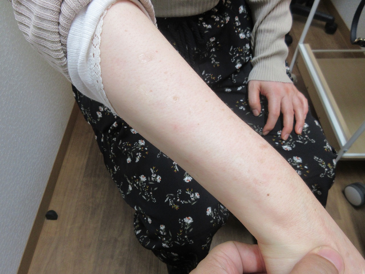 腕のシミのレーザー治療の５か月目の経過