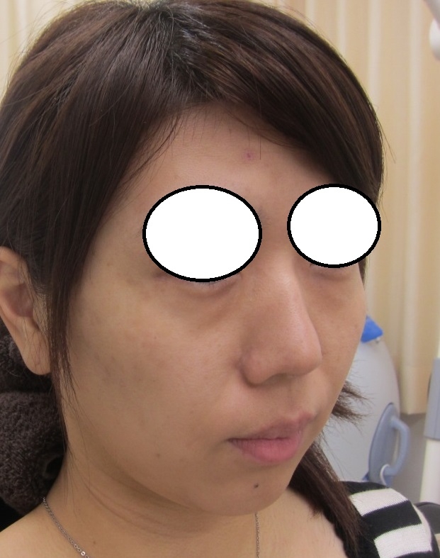 目の下に肌再生FGF注入後1年7か月目　ほうれい線に肌再生FGF注入後10か月目。