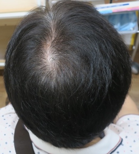 AGA（薄毛）治療開始後2年6か月目。途中の中断がありましたがいい感じで髪にコシも出てきました。