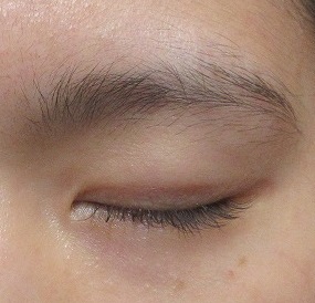 眉頭と眉上の大きいホクロの切除（剥ぎ取り法）。１年３か月目の経過（途中経過のお写真もあり）