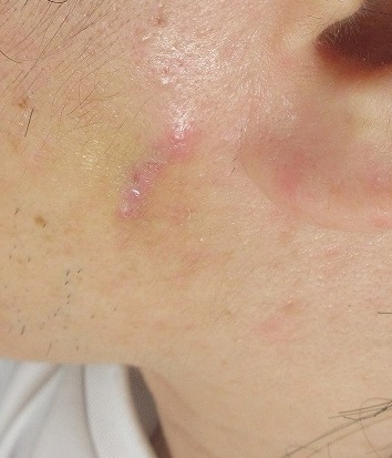 左頬の炎症性粉瘤。2回処置後の経過。