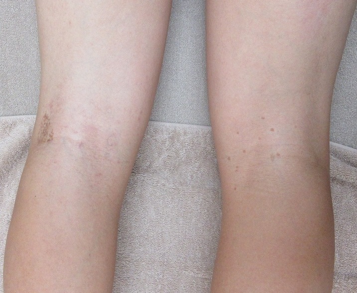メンズの膝裏の大量のイボのレーザー取り放題治療。3か月で2回治療(最後は6月頭）の経過。