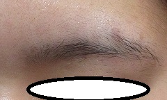眉毛のホクロの複合治療（切除＋レーザー）。3か月目の経過。