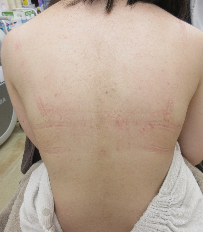 背中の大量のイボのレーザー治療。１カ月半目の経過。