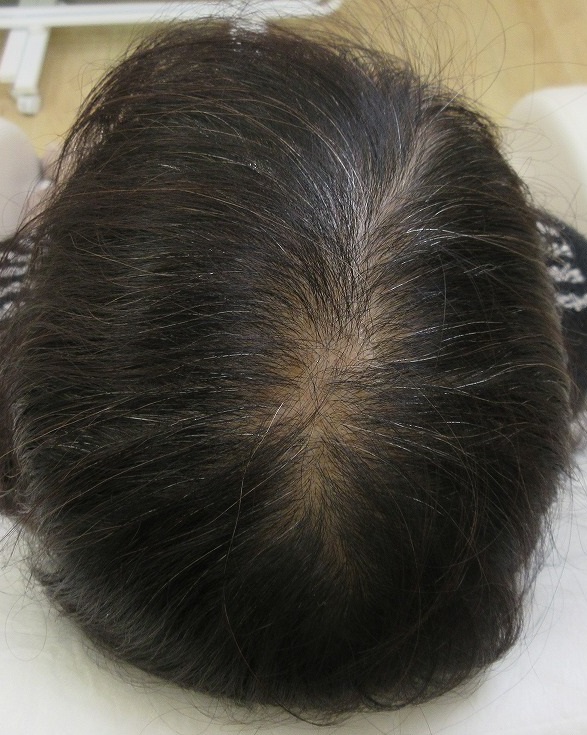女性の薄毛治療。メソセラピー（AGF３９）。４か月目の経過。