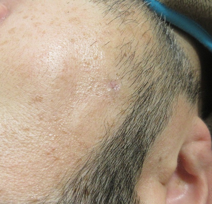 右頬のホクロの切除。１週目の経過。