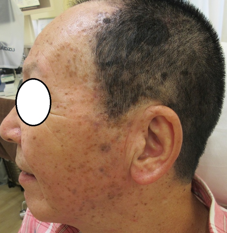 顔の大量のイボ・ホクロ・シミ・その他。あらゆる手段で治療をしてきます。3ヶ月目の経過。
