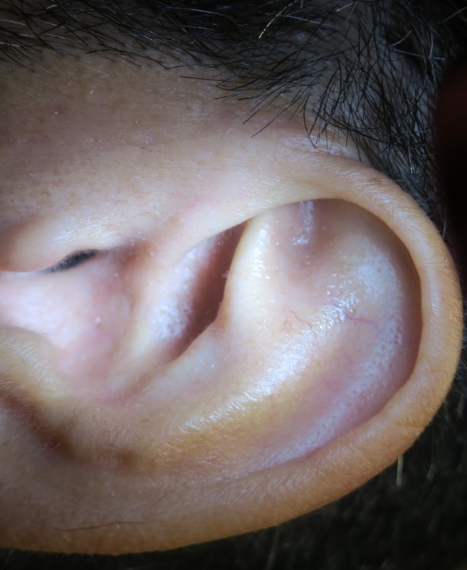 耳のイボ(耳介上部）をレーザーできれいにしました。1週目の経過