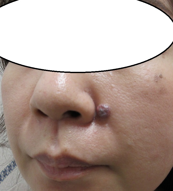 鼻の横の大きいほくろの切除 ３週目の経過 赤みや皮膚の凹凸の具合を参考に 豊洲佐藤クリニック