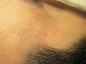 40代男性。こめかみの老人性血管腫（赤イボ）のレーザー治療。1ヶ月目の経過。