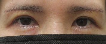 眉下切開法による上眼瞼のたるみの切除術。直後、１週間目の経過。