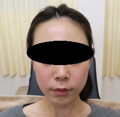 豊洲でお顔の引き締め＋ほうれい線に肌再生FGF注入療法。少しずつ変わっていきましょうね！