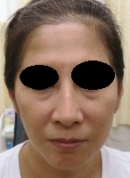 豊洲で目のクマの手術。経結膜的眼窩脂肪切除＋肌再生FGF注入療法。直後の状態。