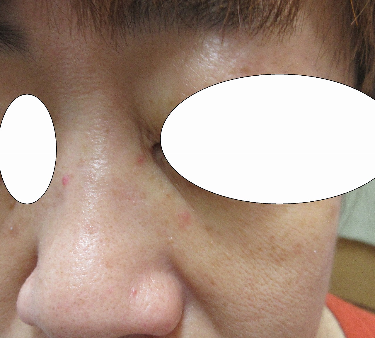 顔のイボの治療。レーザー治療後1週目。赤みなどを参考にしてくださいね。