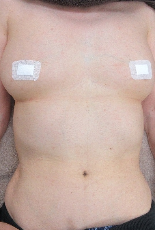 胸腹の大量のイボのレーザー取り放題治療。2カ月半目の経過。60代後半女性。