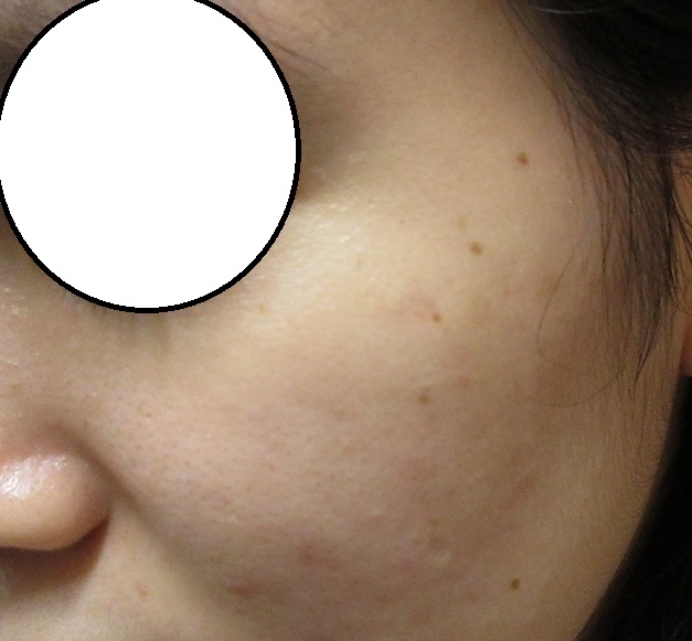 両頬のほくろ切除後８か月目の経過。左右で傷の目立ち方が違います。