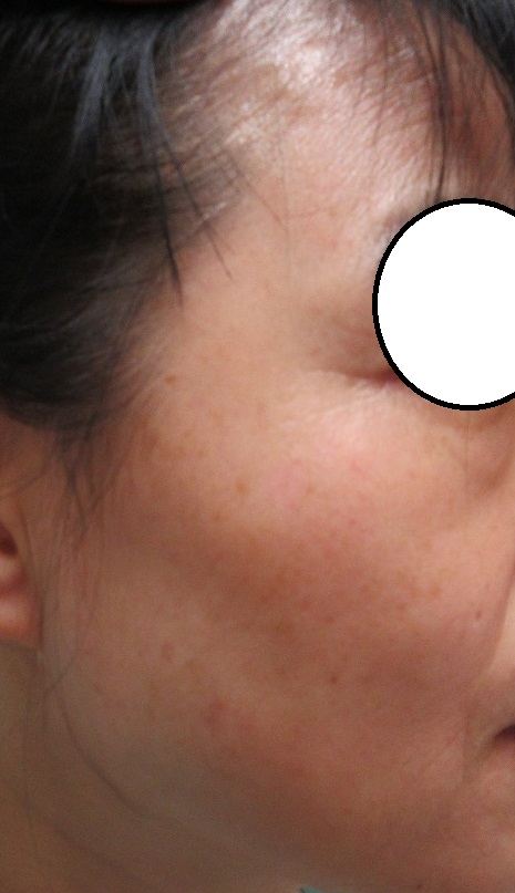 頬のシミのレーザー治療（他院トラブル症例）。3週間目の経過。