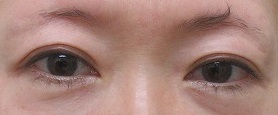 眉下切開法による上眼瞼のたるみ切除術。1年2カ月目の経過。