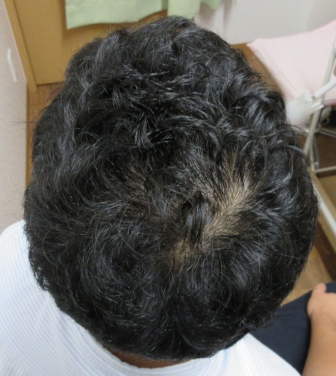 薄毛（AGA）治療、２年３か月目の経過。ドットヘアの内服外用で髪の毛が復活しました。