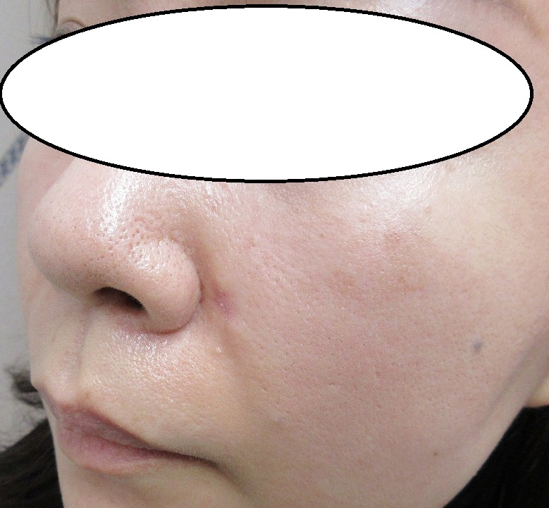 鼻の横の大きいほくろの切除。３週目の経過。赤みや皮膚の凹凸の具合を参考に。