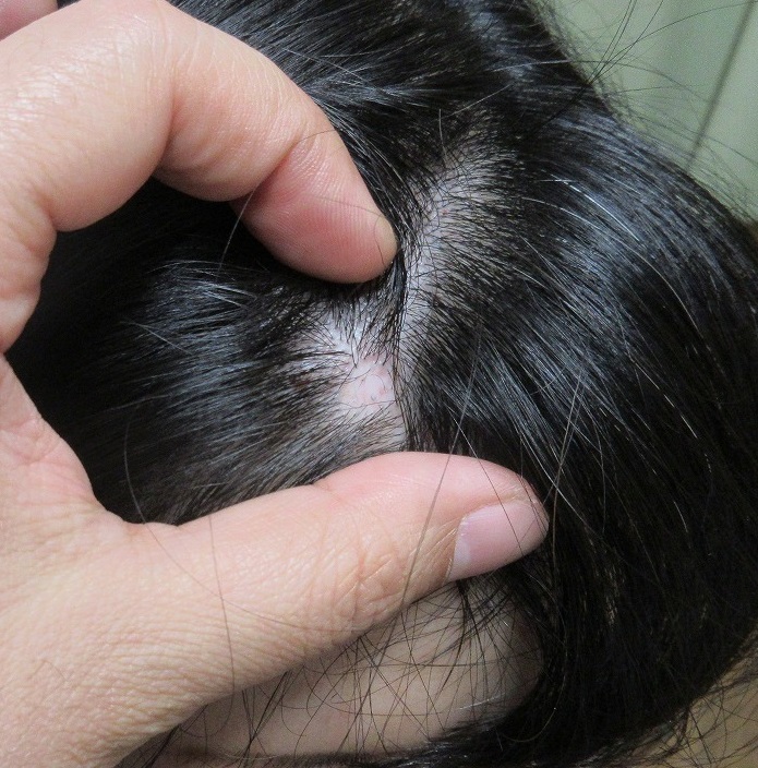 頭皮の1センチ大のホクロの切除。3か月目の経過。