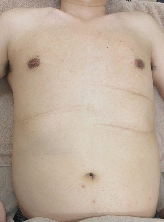 メンズの胸から腹周りの大量のイボのレーザー取り放題治療。6ヶ月目の経過。