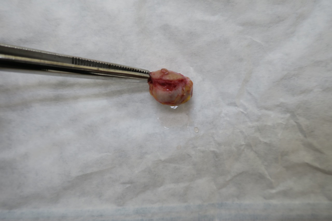 豊洲で首にできた粉瘤を切除。割れた携帯の液晶が刺さってその破片を摘出しました。