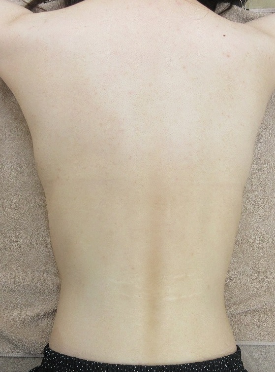 30歳女性。背中のイボのレーザー取り放題治療。1年目の経過。1か月目・3か月目・6か月目の写真もあり