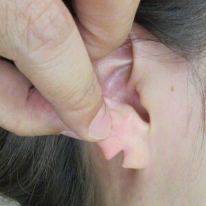 耳垂列の手術。直後の状態。
