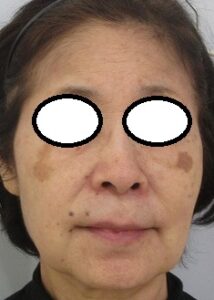 定期的なHIFUとマリオネットラインへのヒアルロン酸注入。８年目の経過。