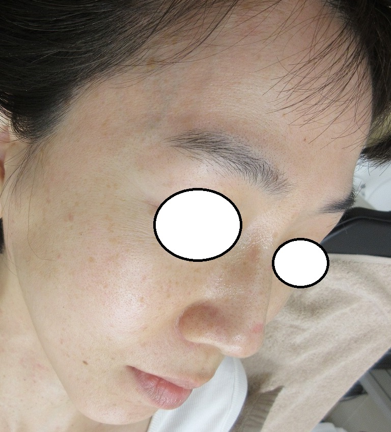 顔の大量のイボレーザー取り放題治療。3週目の経過。