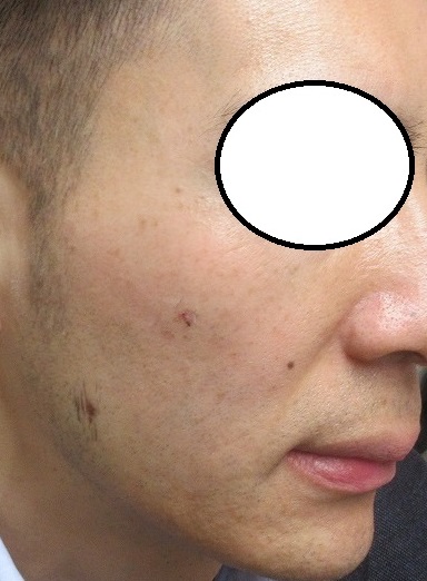 メンズの顔の大量のイボのレーザー取り放題治療＋シミレーザー。2週目の経過。