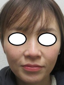 エラボトックス５年５か月目の経過。いい状態をキープ中。