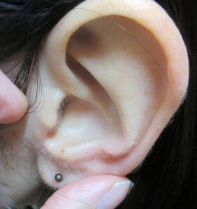 30代女性。耳の穴（外耳道）の出入り口のホクロの剥ぎ取り法。1年８ヶ月目の経過。