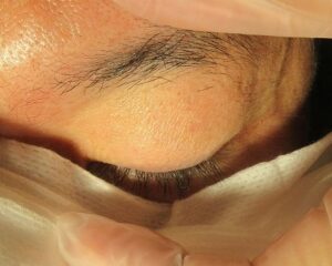 50代男性。瞼のイボのレーザー治療。直後・1年目の経過。