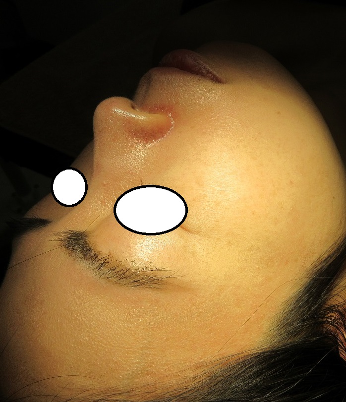 40代女性。顔のイボのレーザー取り放題治療の様子。7ヶ月目。