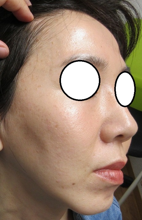 40代女性。顔のイボのレーザー取り放題治療。2年目の経過。