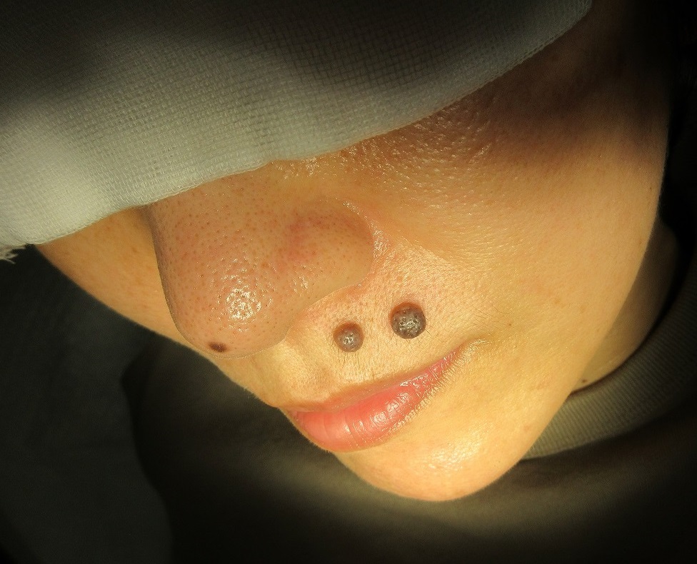 鼻の下の大きいほくろを２個切除 １ ５か月目の経過 豊洲佐藤クリニック
