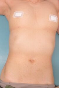 55歳女性。胸腹のイボのレーザー治療。1年2カ月目の経過。