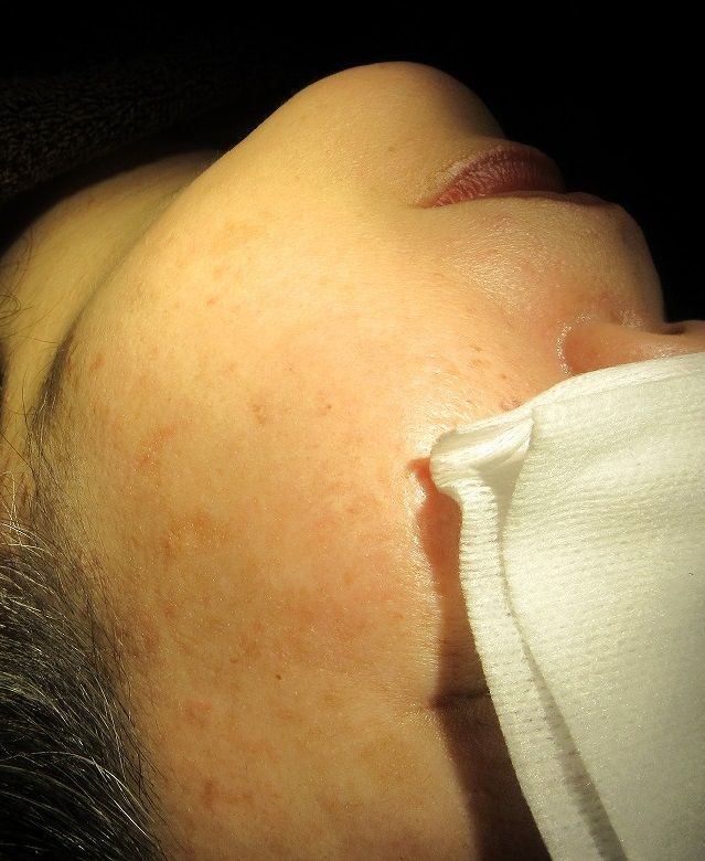 50代女性、顔のイボのレーザー取り放題治療。2カ月目の経過。