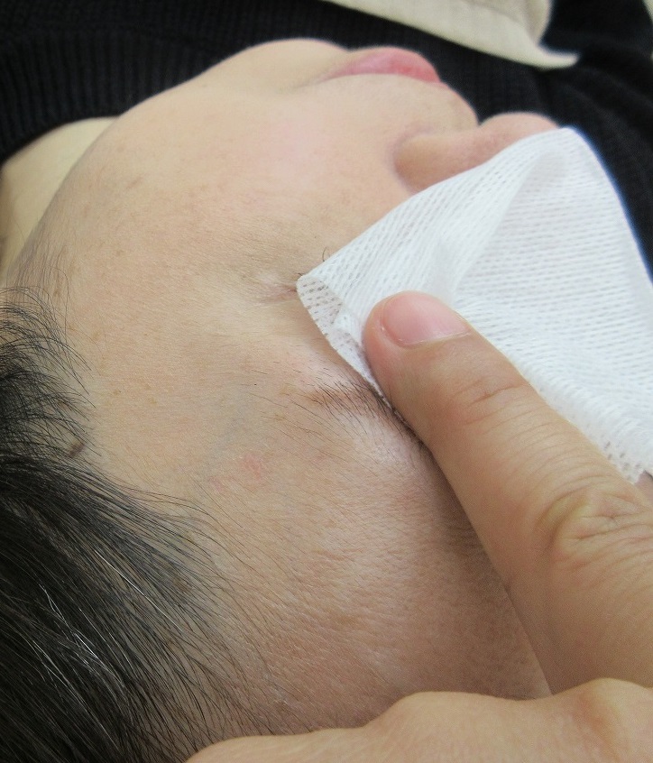 顔のイボレーザー治療。1か月目の経過。