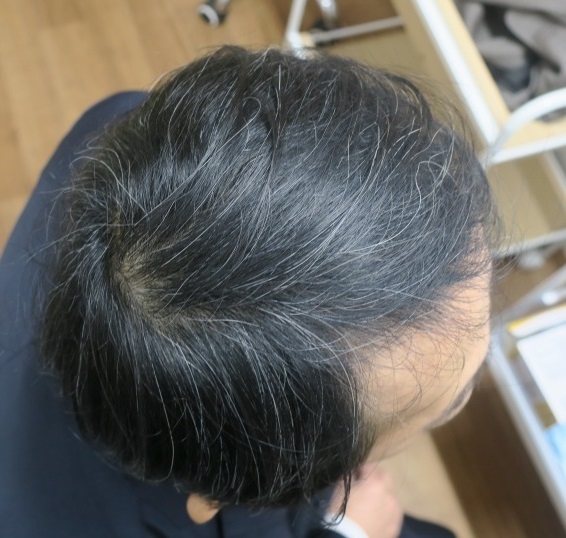 豊洲で薄毛治療(AGA治療）50代男性。3年でかなり激変しました。
