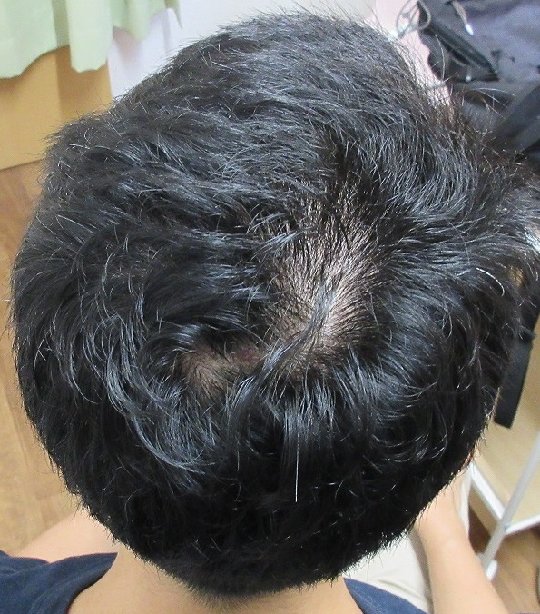 豊洲で薄毛（AGA）治療。３年半の経過。外用の追加でもう少し生えてきそうな感じです。