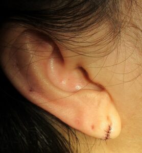 20代女性。右耳垂裂の手術後11日目の経過（左耳は5年前に施行しそれの写真もあり）。