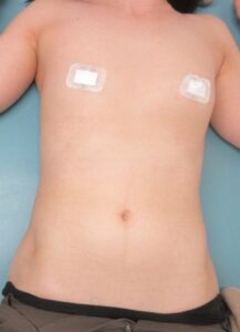 50歳女性の胸腹の大量のイボのレーザー治療の１年目の経過。